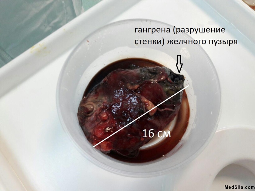 удаленный желчный пузырь